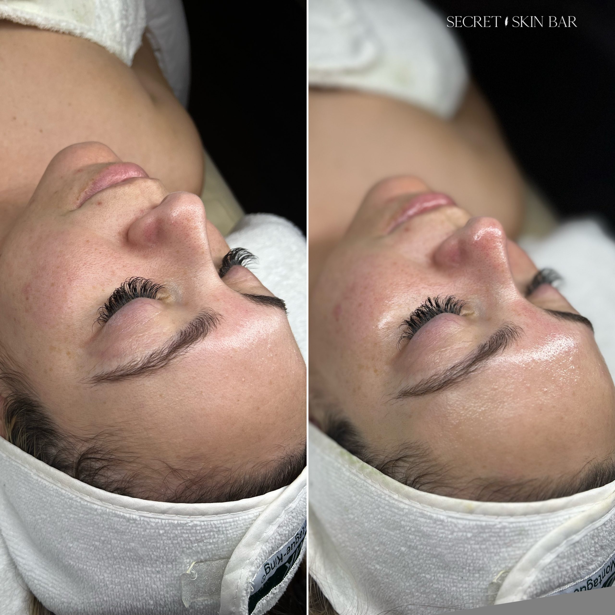 Client skin treatment photo 6