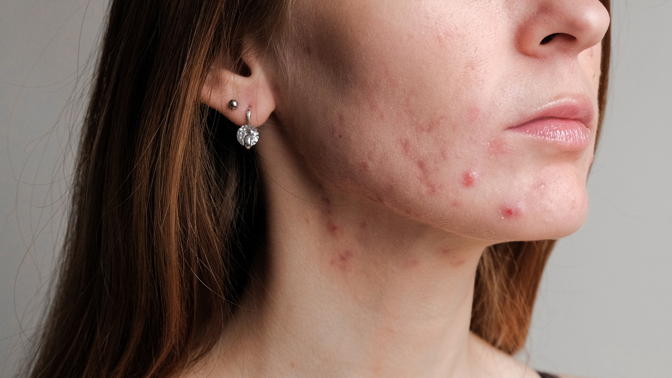 The Fight Against Acne: What's the Best Way to Treat Acne?
